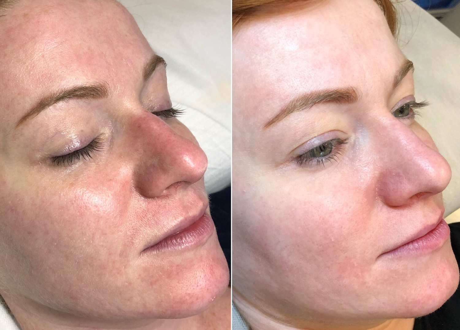 BB Glow Antes e Depois - Saiba tudo sobre o tratamento BB Glow